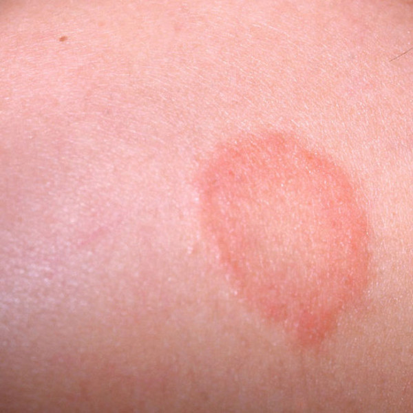 circular rash on neck - pictures, photos